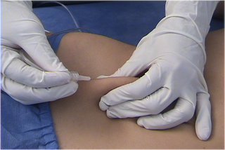 EFECTOS DE LA CARBOXITERAP&Iacute;A